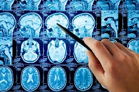 Alte dosi di vitamine del gruppo B aiutano a prevenire il morbo di Alzheimer