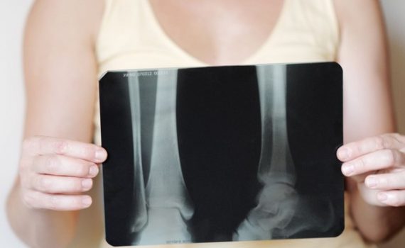 Osteoporosi e assunzione di ferro nella dieta