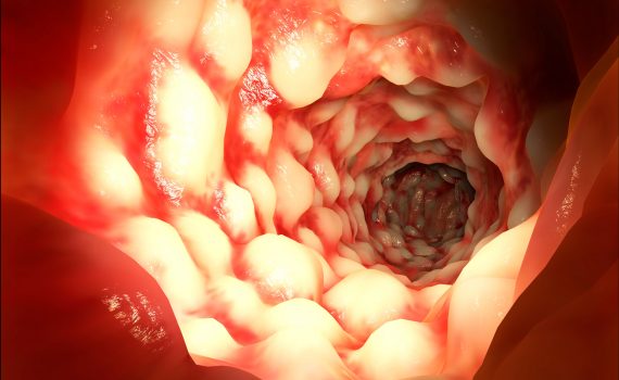 L’alimentazione e il morbo di Crohn