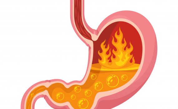 Reflusso gastroesofageo: come alleviare i sintomi