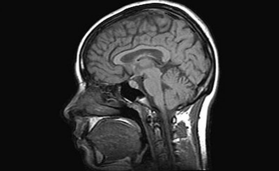 O mal de Alzheimer pode ser identificado pelo marcador biológico ADAM10