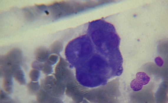 Tratamento com vitamina C intravenosa pode ajuda a quimioterapia a eliminar células cancerígenas