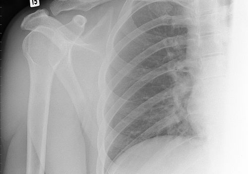 Identificado hormônio que tem impacto direto sobre a osteoporose