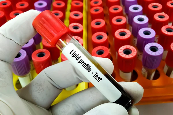 Amostra de sangue para analisar os perfis lipídicos de pacientes com Alzheimer. Amostra de sangue para analisar os perfis lipídicos de pacientes com Alzheimer.