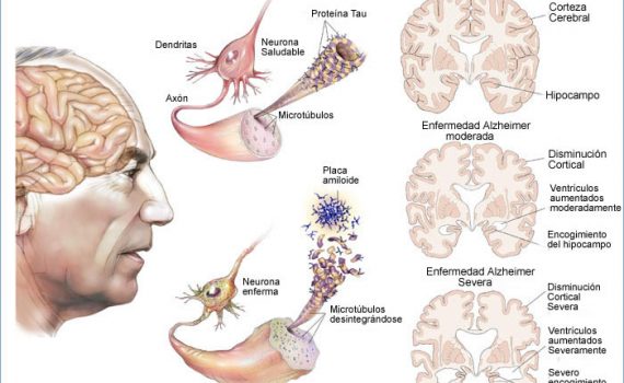 Se incrementa la esperanza de vida en España, pero también las enfermedades mentales