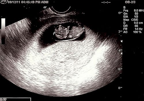 Efectos del ejercicio de mujeres embarazadas sobre el crecimiento fetal anormal.