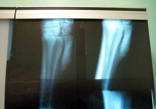 Se lograría millonario ahorro si se cumplieran las recomendaciones de calcio y vitamina D