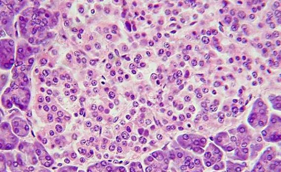 Un tercio de los ancianos en España padecen de diabetes