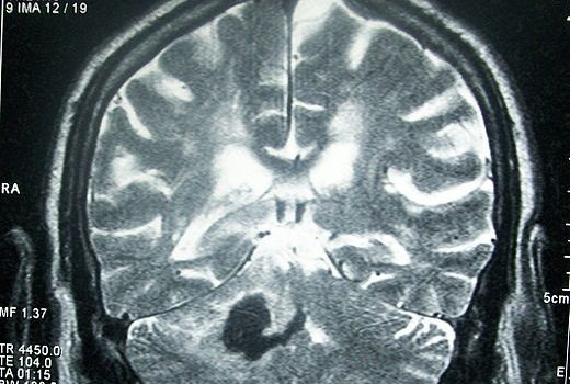 Deficiencia de hierro podría aumentar riesgo de ACV