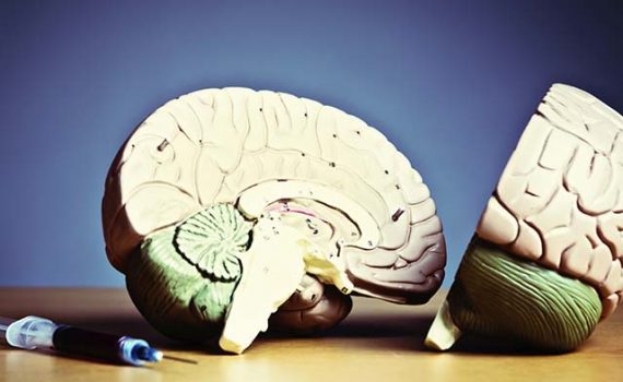 Trabajar muchas horas incrementa el riesgo de embolia cerebral