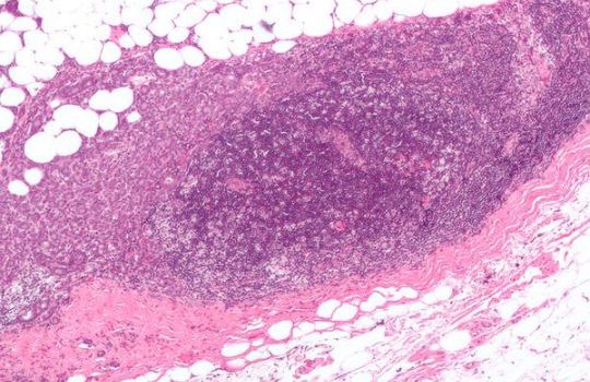 Factores para prevenir el cáncer de mama