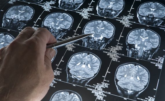 Inteligencia artificial para el diagnóstico prematuro del Alzheimer