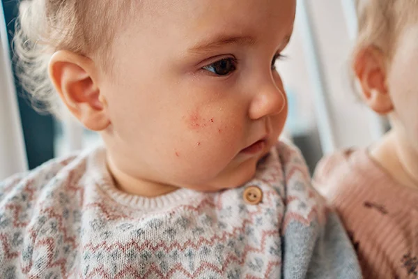 Microbiota intestinal y alergias infantiles: avances científicos y oportunidades de prevención